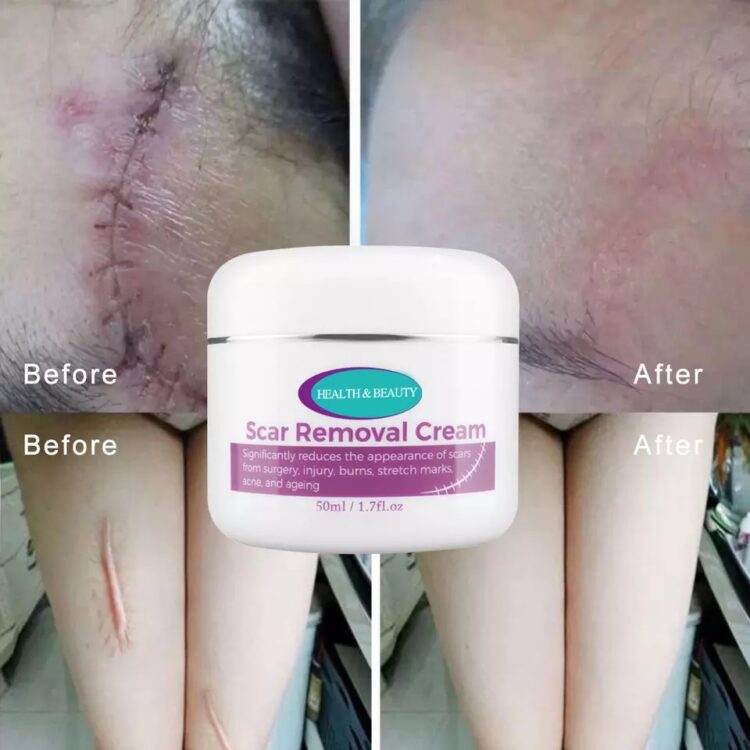 ⁦Magic scar removal cream⁩ - الصورة ⁦5⁩